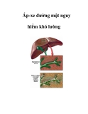 Áp-xe đường mật nguy hiểm khó lường  
