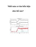 Nhồi máu cơ tim biểu hiện như thế nào?  
