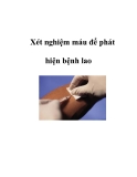 Xét nghiệm máu để phát hiện bệnh lao  