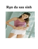 Rạn da sau sinh