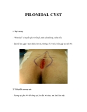 PILONIDAL CYST 