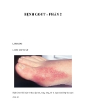 BỆNH GOUT – PHẦN 2 