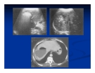 Chẩn doán hình ảnh : Gan - Mật part 9