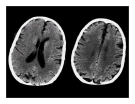 CT Scan trong tai biến mạch máu não  part 6