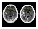 CT Scan trong tai biến mạch máu não  part 8