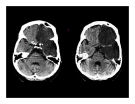 CT Scan trong tai biến mạch máu não  part 10