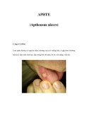 APHTE (Apthousus ulcers) 