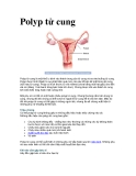 Polyp tử cung 