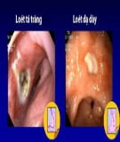  Bệnh học thực hành - Dạ dày tá tràng loét (Ulcère Gastrique, Duodenal - Gastroduodenal Ulcer) 