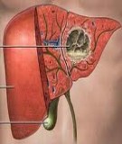 Bệnh Học Thực Hành: Áp xe gan (Can Ung - Liver Abcess) 