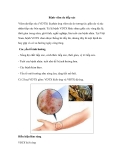 Bệnh viêm da tiếp xúc 