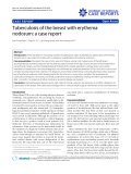 Báo cáo y học: " Tuberculosis of the breast with erythema nodosum: a case report"
