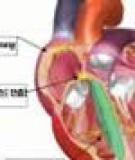 Blốc nhĩ thất độ II týp 2 (Mobitz II)