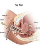 Tại sao phụ nữ nên làm xét nghiệm Pap Smear?