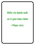 Điều trị bệnh mắt cá ở gan bàn chân (Mụn cóc)