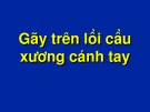 Giải phẫu bệnh: Gãy trên lồi cầu xương cánh tay