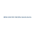 HÌNH ẢNH TỔN THƯƠNG XOANG HANG