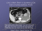 Chuẩn đoán X quang trong hội chứng màng phổi