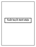 Xuất huyết dưới nhện