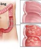 Ðể bệnh đại tràng co thắt