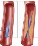 Phòng ngừa xơ vữa động mạch như thế nào?
