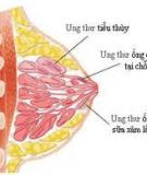 Ung thư vú và thai nghén: Những điều cần biết