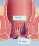 Cách phân loại về bệnh trĩ