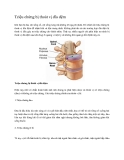 Triệu chứng bị thoát vị đĩa đệm