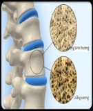 Điều trị loãng xương: Tiếp cận vấn đề qua y học thực chứng - Nguyễn Văn Tuấn