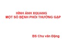 Bài giảng Hình ảnh Xquang một số bệnh phổi thường gặp – BS. Chu Văn Đặng